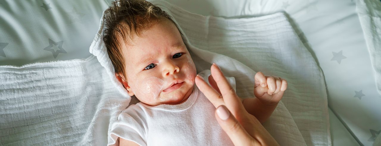 Atopijski dermatitis kod beba i djece: dermatologinja objašnjava što bi roditelji trebali znati