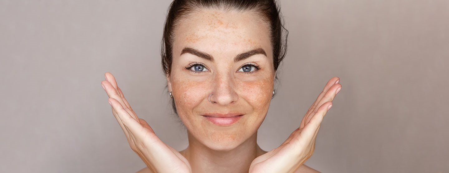 Ukloniti pigmentacijske mrlje: što prema savjetu dermatologinje zaista pomaže