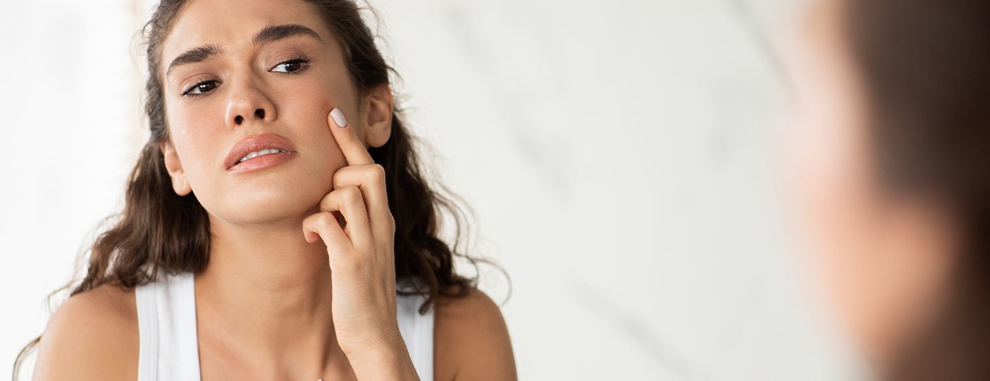 Hormonalne akne: dermatologinja objašnjava što se može učiniti protiv njih