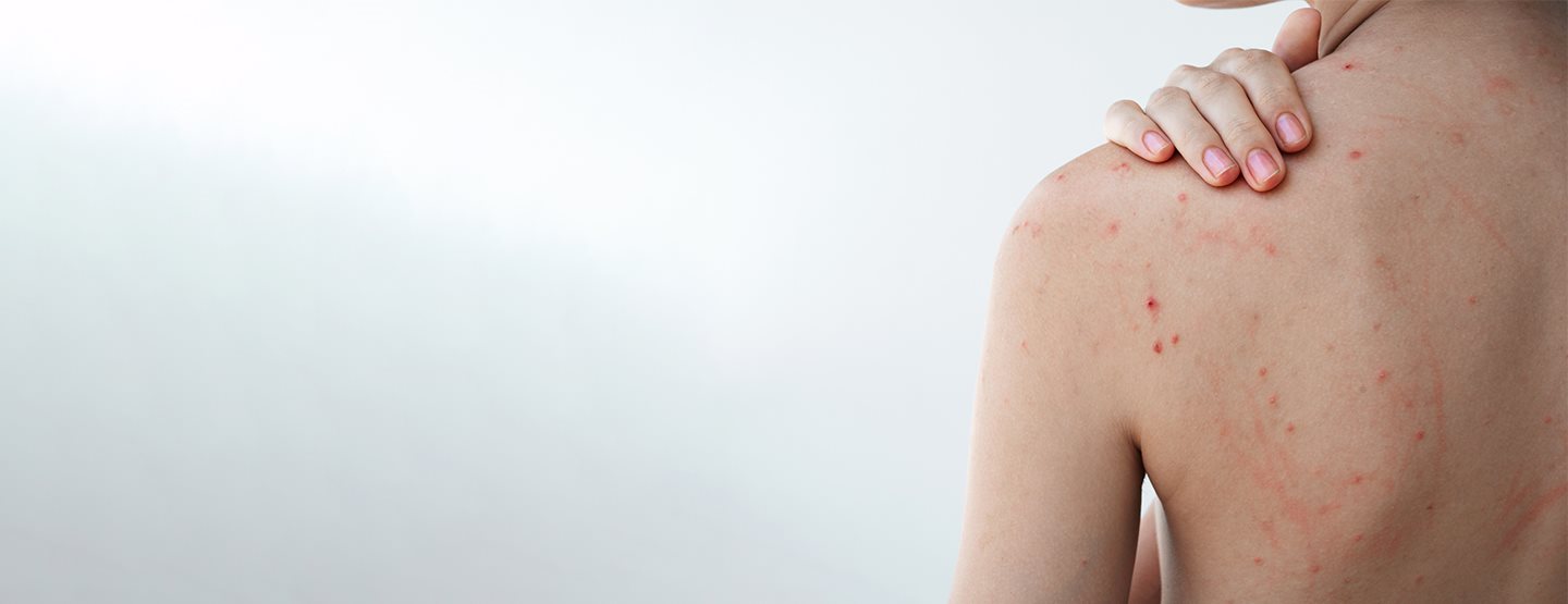 Prištići na leđima: prema dermatologinji, ovo uistinu pomaže protiv prištića na leđima