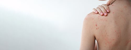 Prištići na leđima: prema dermatologinji, ovo uistinu pomaže protiv prištića na leđima