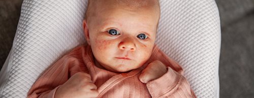 Akne kod beba: što učiniti protiv toga prema riječima dječje dermatologinje